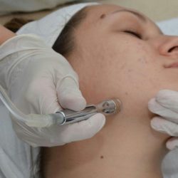 procedure mikrodermoabrazija 1 1 e1454193849337