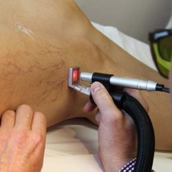 laser treatment for varicose veins