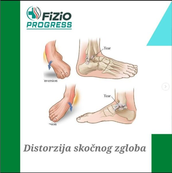 fizio progress distorzija skocnog zgloba