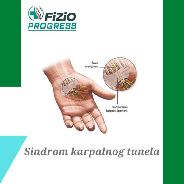 fizio progress sindrom karpalnog tunela